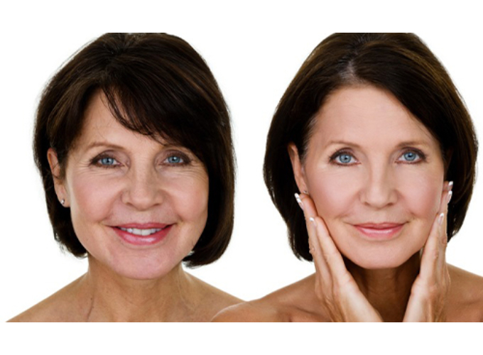 Kollagénes arcbőr regeneráló kezelés